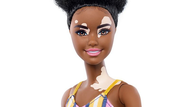 Barbie-mit-Pigmentstoerung-658x370-dace8dd7c9d332c7.jpg