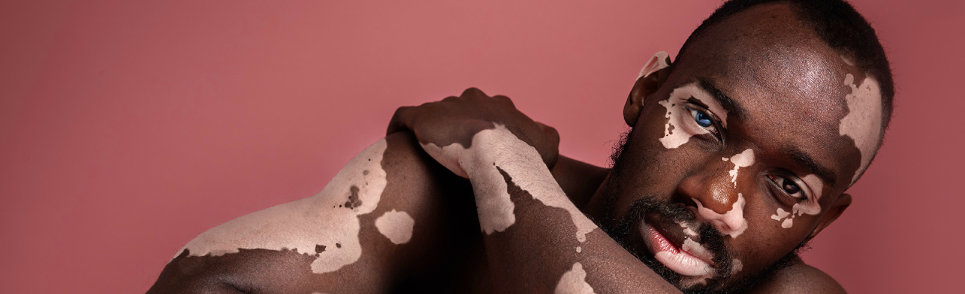 causes-of-vitiligo-1.png