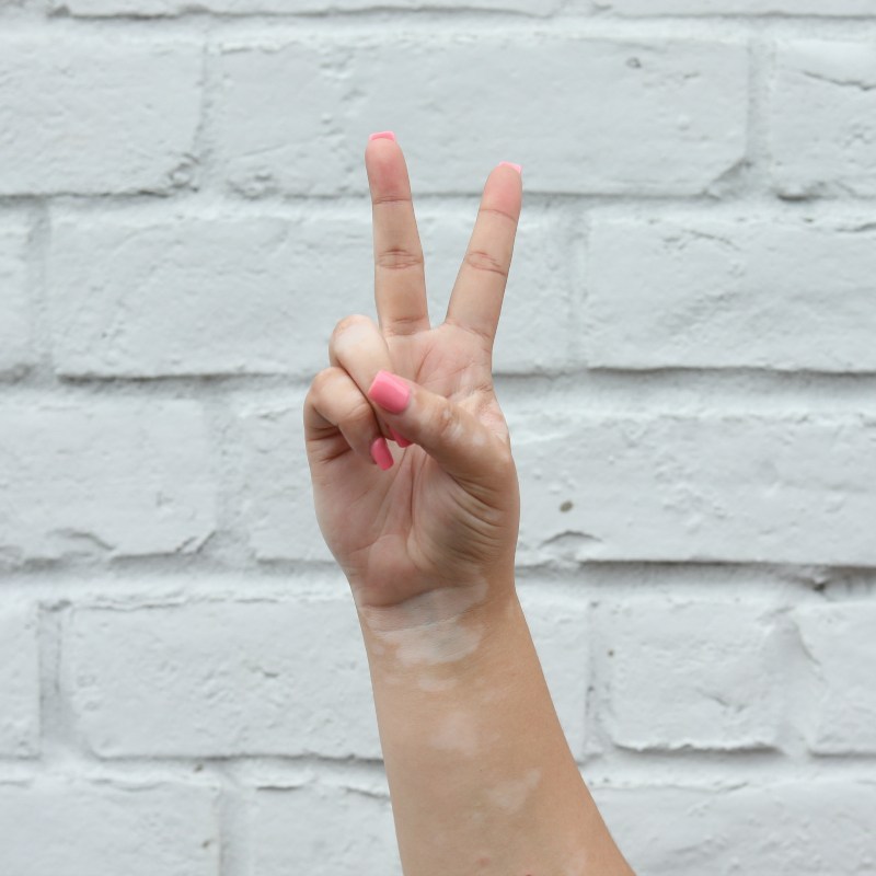 vitiligo_113.jpg