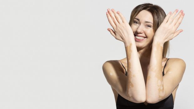 unique-young-woman-with-vitiligo-skin-scaled-pcprgn2t9dl0mpadwizpnz13h70tfmw0fro9s5888c.jpeg