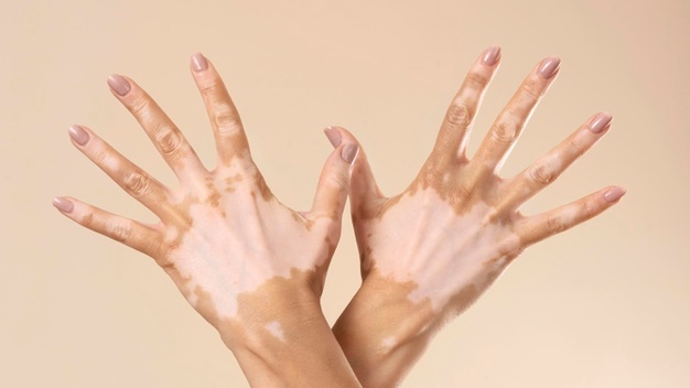 young-woman-showing-her-vitiligo-skin-parts_23-2148994043.jpeg