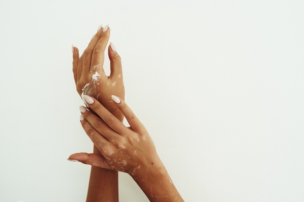 woman-pouring-body-care-cream-from-bottle-her-hand-with-vitiligo_121946-2203.jpeg