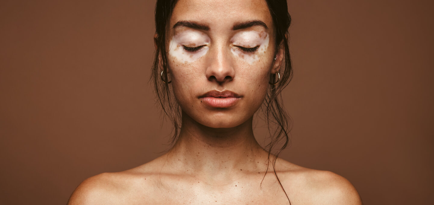 Vitiligo-hero.jpeg